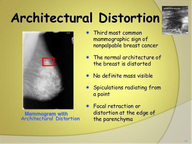 non palpable breast cancer Mature asset advisors llc